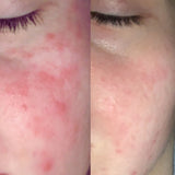 psoriasis before and after on face