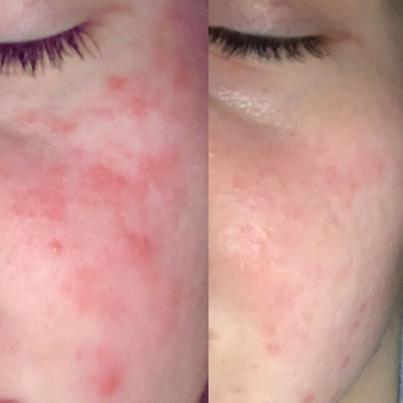 psoriasis before and after on face