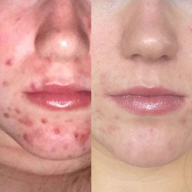 acne effective treatment