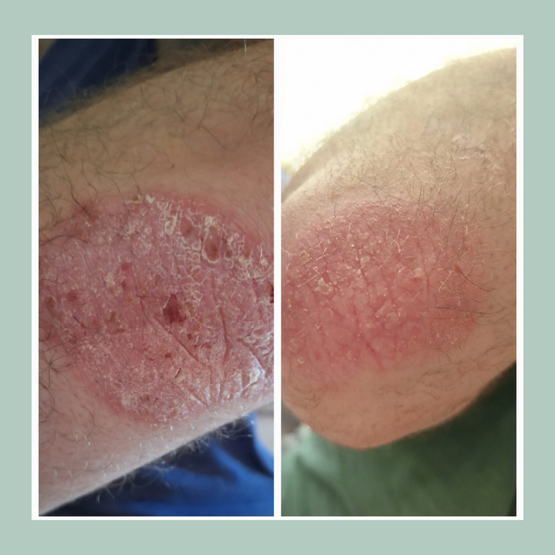 Botanical Blend 8-Hour Relief Moisturizer