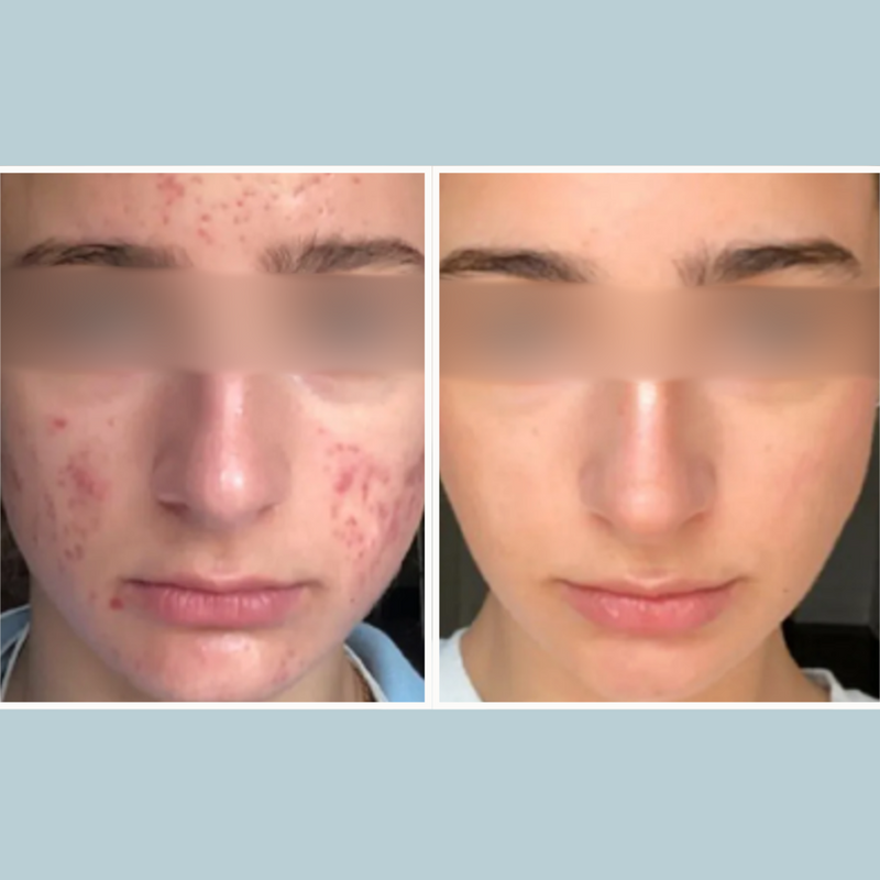 Ultimate Acne Control Bundle