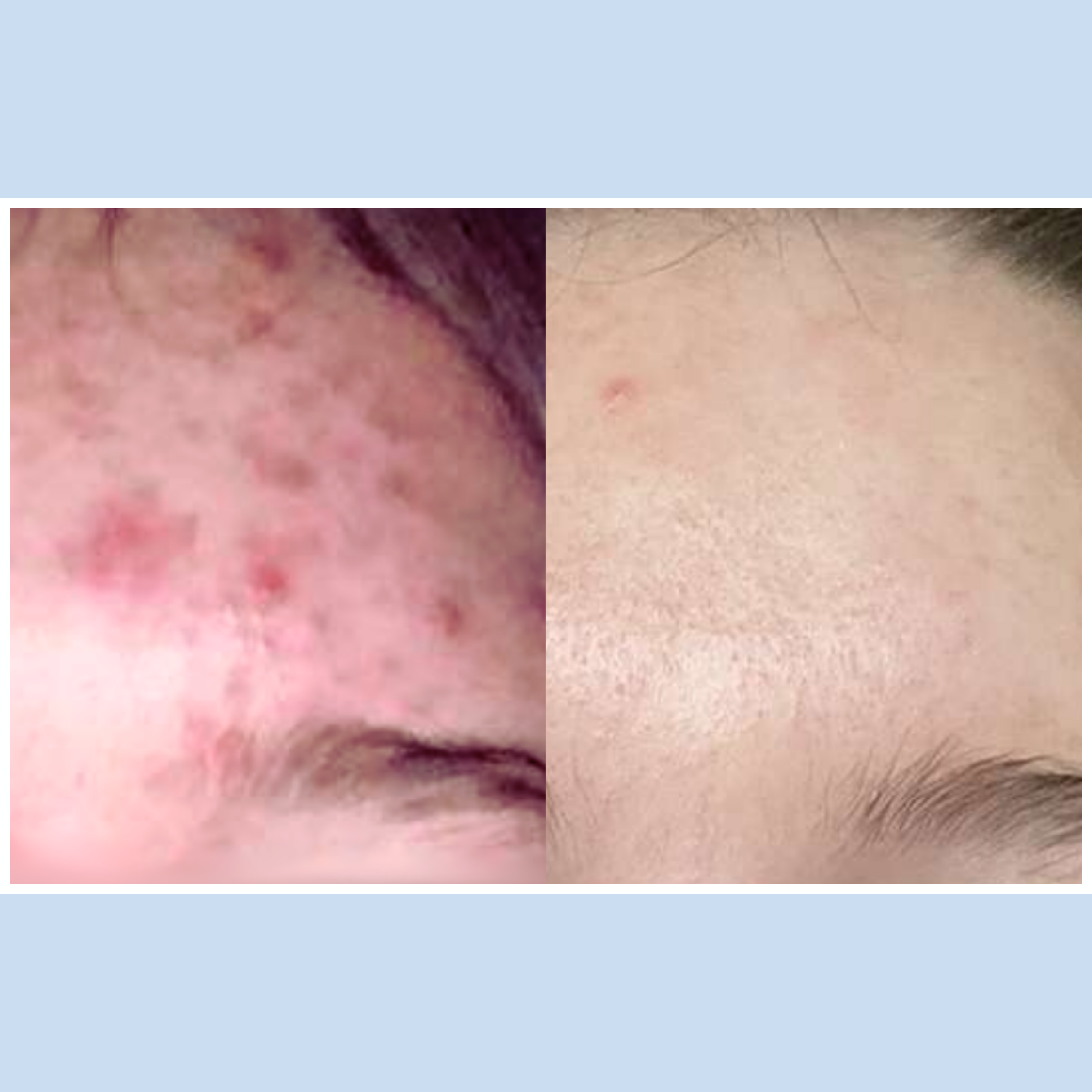 Acne Prone Skin Bundle – MGC Derma EU