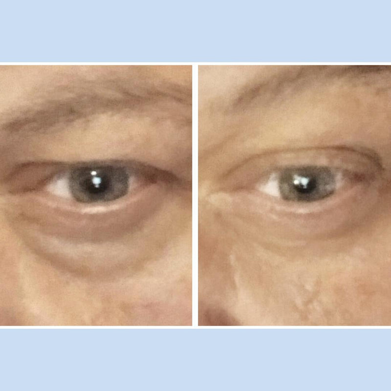 Before and after comparison of a person's eye with visible aging signs.