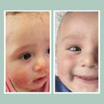Eczema Relief Bundle