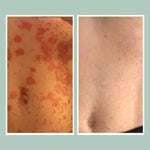 Psoriasis Calming Bundle
