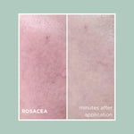 Rosacea and Redness Treatment Bundle