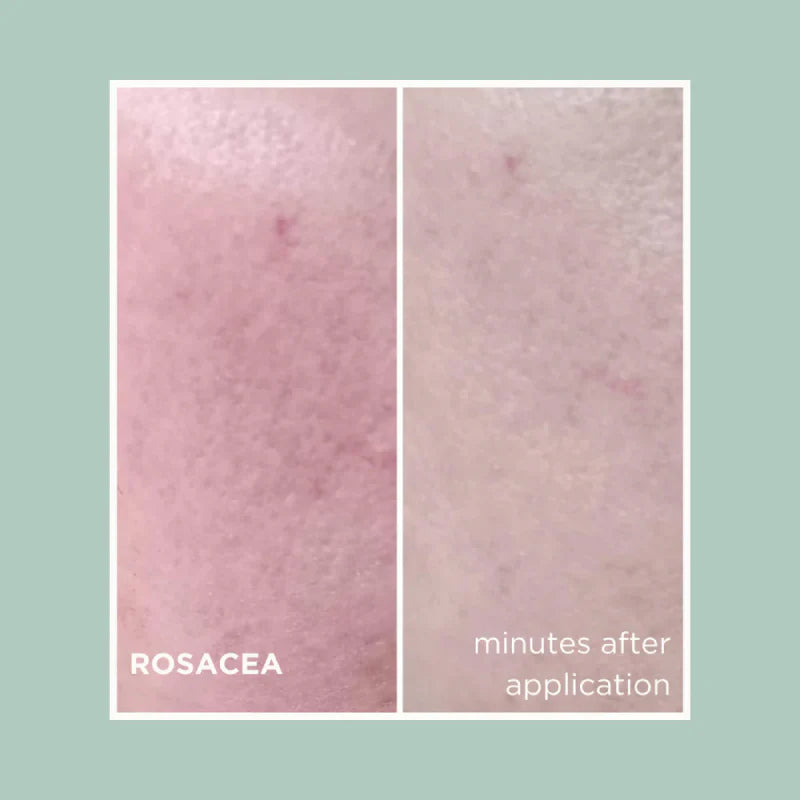 Rosacea and Redness Treatment Bundle