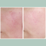 Rosacea Treatment Bundle