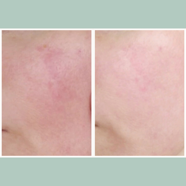 Rosacea and Redness Treatment Bundle